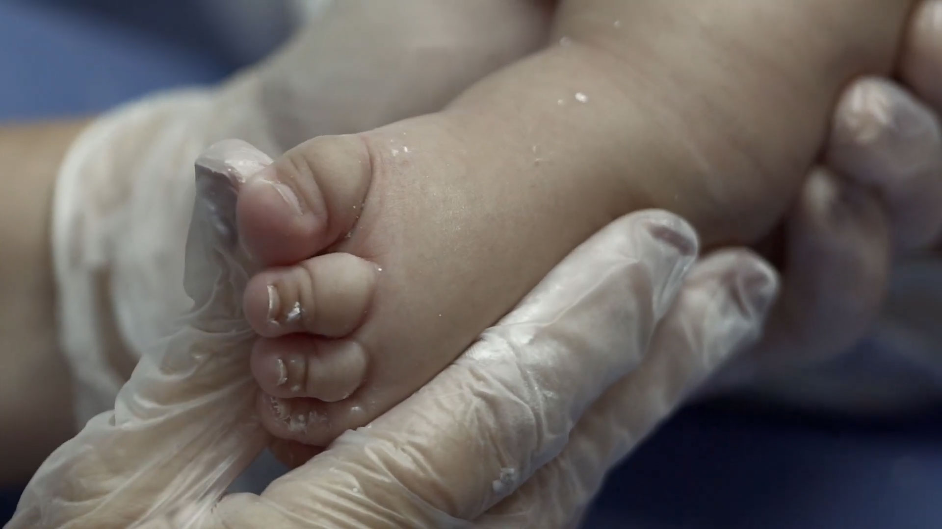 Método Ponseti en Colombia - Cortometraje Documental realizado por TRAGALUZ Laboratorio Audiovisual para Rotary Internacional